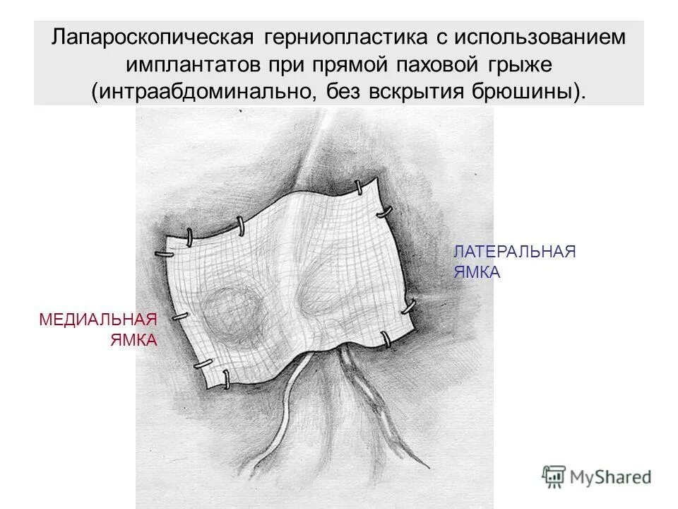 Паховая грыжа сколько больничный. Герниорафия пупочной грыжи. Эндоскопическая герниопластика паховой грыжи. Лапароскопическое ушивание паховой грыжи.