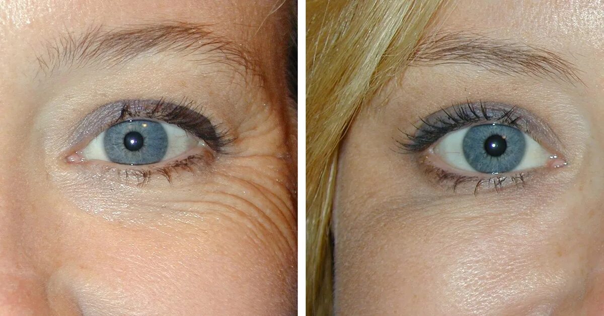 Биоревитализация вокруг глаз до и после. Мезотерапия вокруг глаз до и после. Биоревитализация глаз до и после.