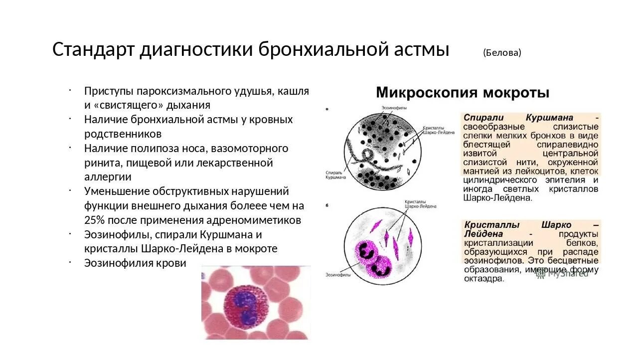 Реакция мокроты. Исследование мокроты при бронхиальной астме. Спирали Куршмана и Кристаллы Шарко-Лейдена. Исследование мокроты спирали Куршмана. Спирали Куршмана и Кристаллы Шарко-Лейдена в мокроте.