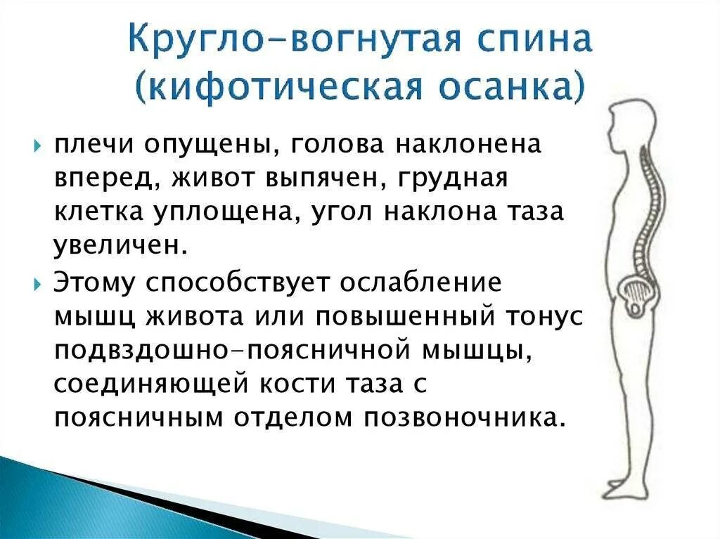 Круглая спина. Кругло вогнутая осанка. Вогнуто круглая спина. Круглая спина, кругловогнутая плоская. Тип осанки плоская спина.