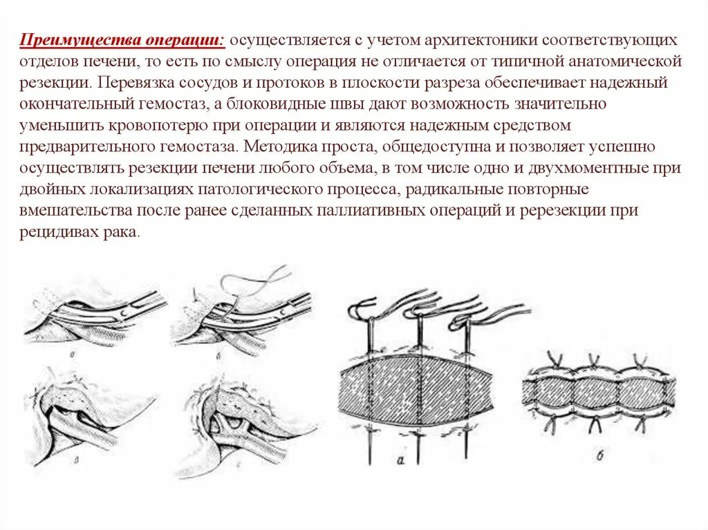 Операция резекция печени. Двухмоментная ампутация схема. Операция резекции верхушки корня зуба. Показания к резекции верхушки корня. Хирургическая диаметрия.