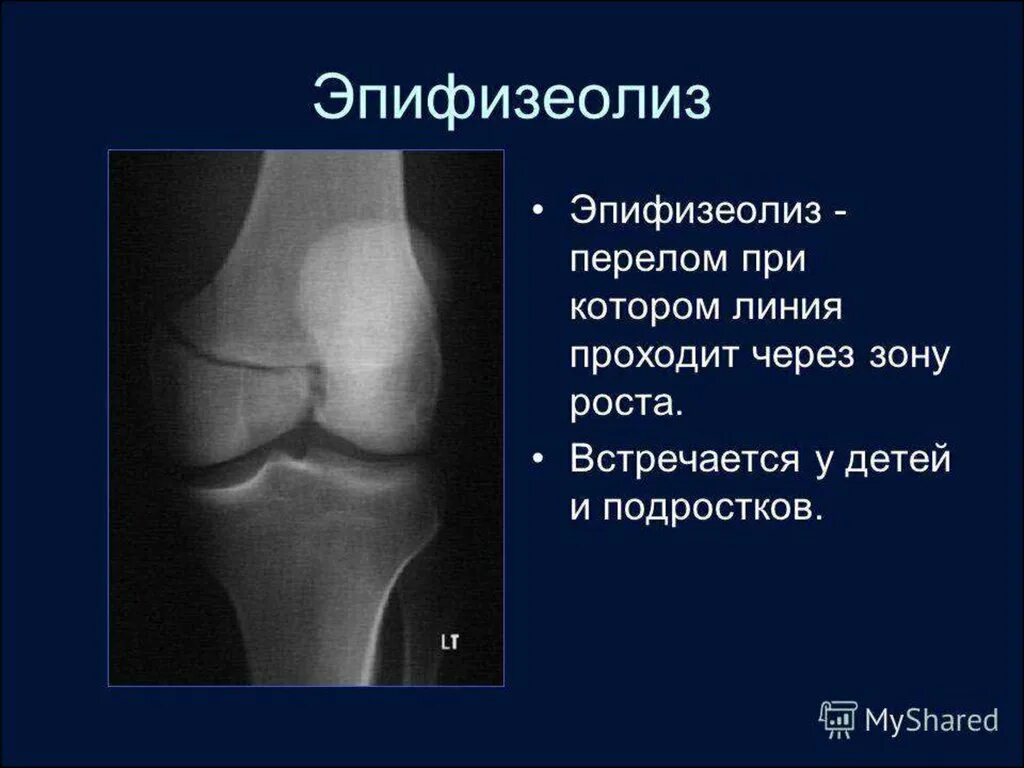 Повреждение зоны роста. Перелом эпифизеолиз большеберцовой кости. Эпифизеолиз дистального конца лучевой кости. Перелом эпифиза большеберцовой кости. Эпифизеолиз дистального эпифиза бедренной кости у детей.