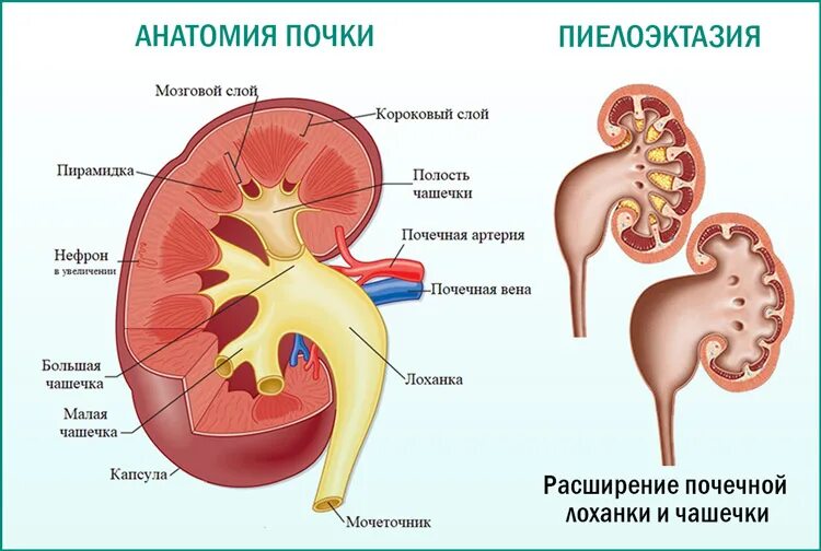 Что значит расширенная лоханка почки