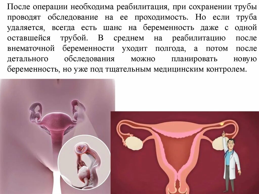 Можно забеременеть с одной трубой