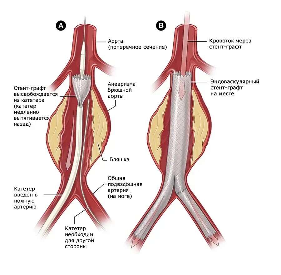 Аневризма стент. Стент графт аорты операция. Стент графт аневризма брюшной аорты. Эндоваскулярное протезирование брюшной аорты. Аневризма брюшной аорты протез.