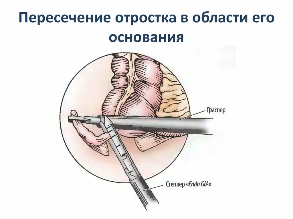 Что можно после операции удаление аппендицита. Рубец лапароскопическая аппендэктомия. Ход операции лапароскопия аппендицита. Эндоскопическая аппендэктомия. Лапароскопическая аппендэктомия лапароскопия.