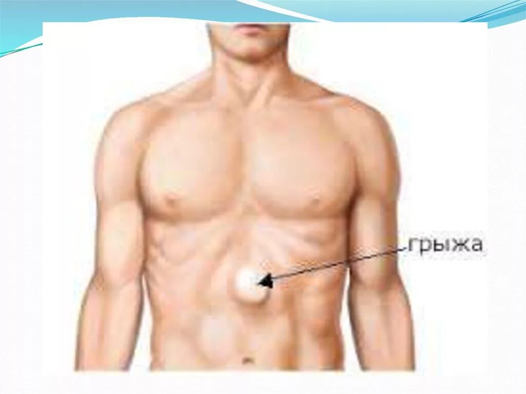 Грыжа под ребрами. Грыжа белой линии живота. Грыжа белойтлинии живота.