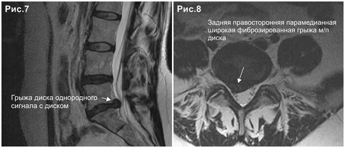 Lumbar disc herniation. грыжа л5-s1 секвестрированная. секвестрированная грыжа л3 л4. каудальная миграция грыжи. резорбция межпозвонковой грыжи.