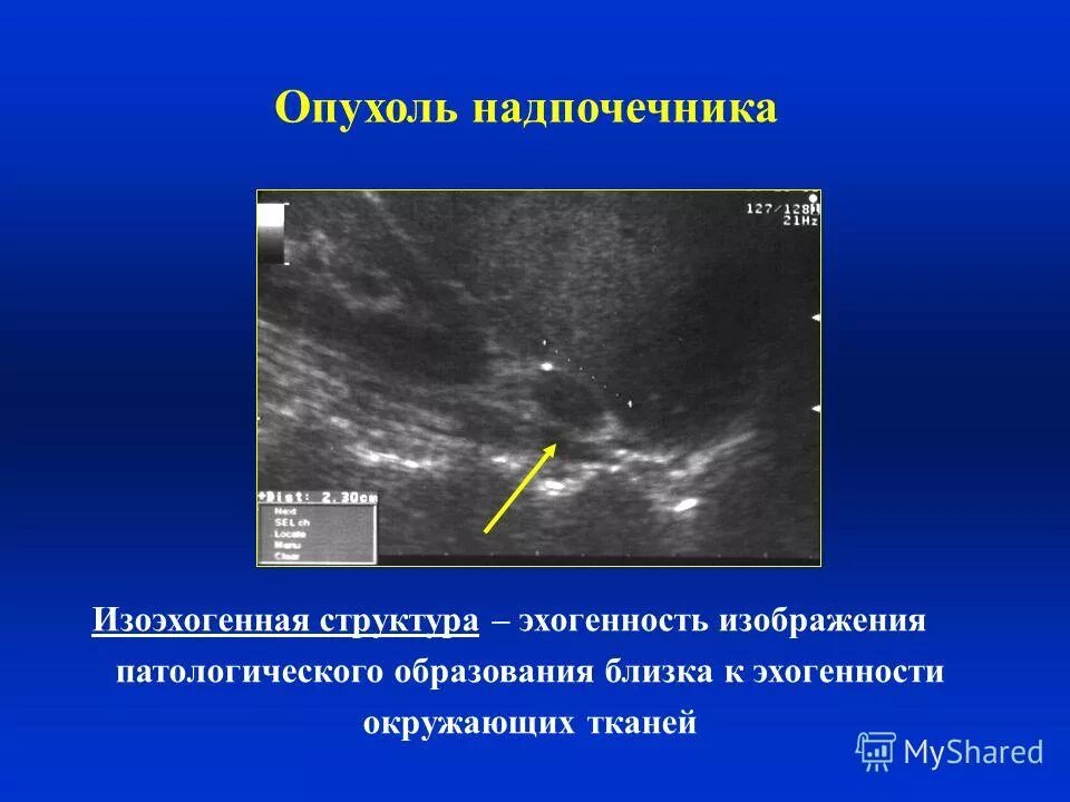 Аденома надпочечника на УЗИ. Изоэхогенное образование щитовидной железы УЗИ. УЗИ признаки опухоли надпочечника. Феохромоцитома надпочечника УЗИ.