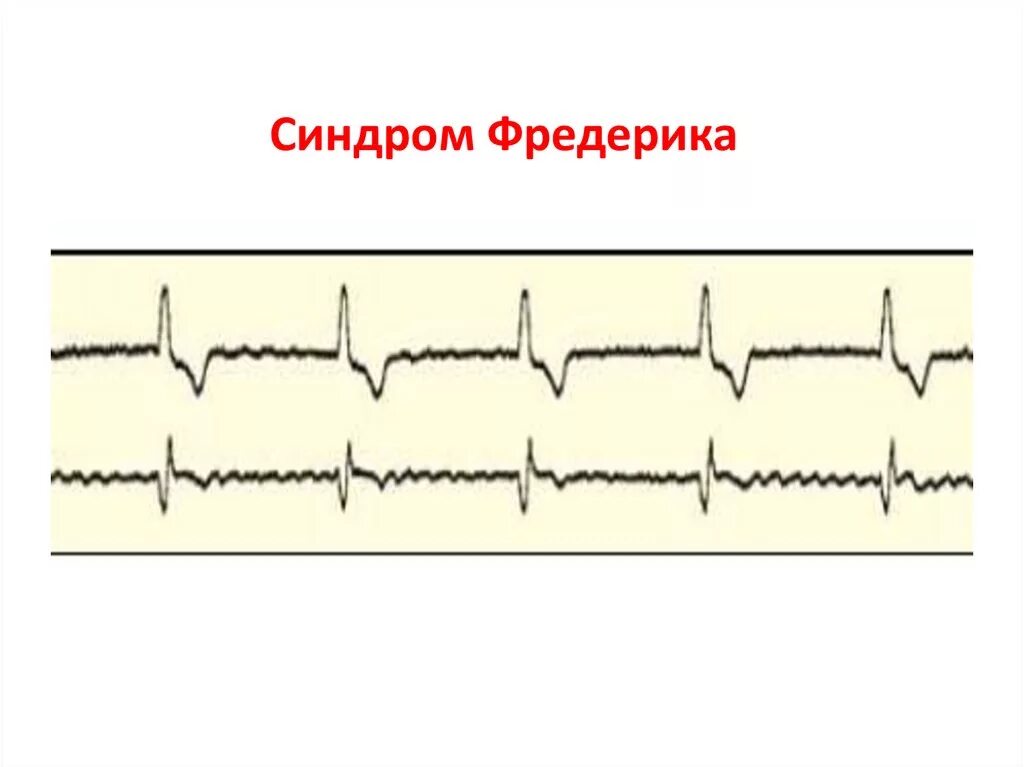 Блокады при фибрилляции предсердий. Фредерик на экг. Экг при фибрилляции предсердий. Симптом фридриха экг. Сочетание фибрилляции предсердий и полной ав блокады.