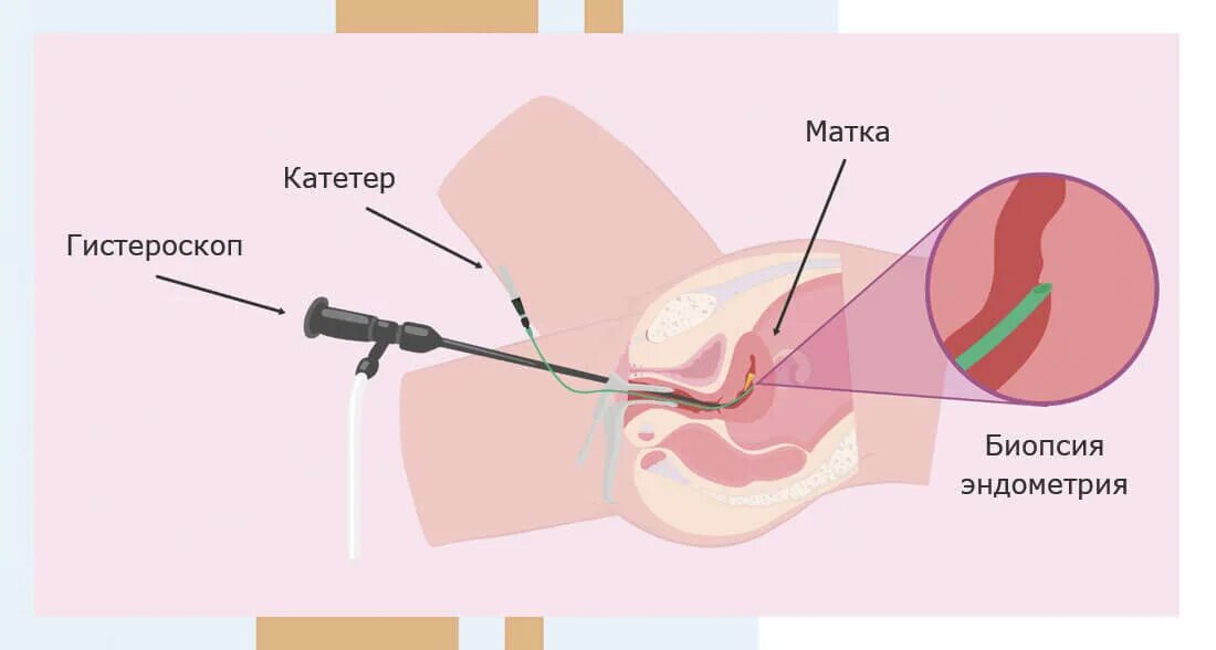 Биопсия полости матки. Аспирационная пайпель биопсия. Пайпель-биопсия (аспирационная биопсия). Пайпель-биопсия (аспирационная биопсия эндометрия). Пайпель биопсия полости матки.