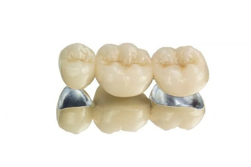 Металлокерамическая облицовка. Металлопластмассовые коронки уступ. Коронка металлокерамическая (золотоплатиновый сплав). Металлокерамическая коронка «ips классик». Металлокерамическая облицовка.