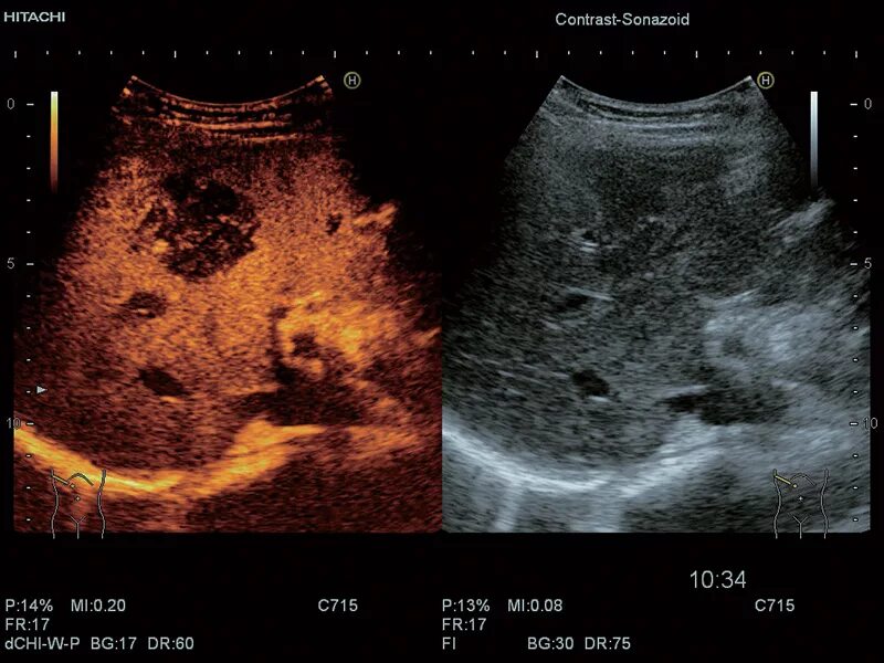 УЗИ печени контрастирование. УЗИ С эхоконтрастирование с контрастных препаратов. Эхоконтрастные методы ультразвукового исследования. Тканевое эхоконтрастирование. После узи болит