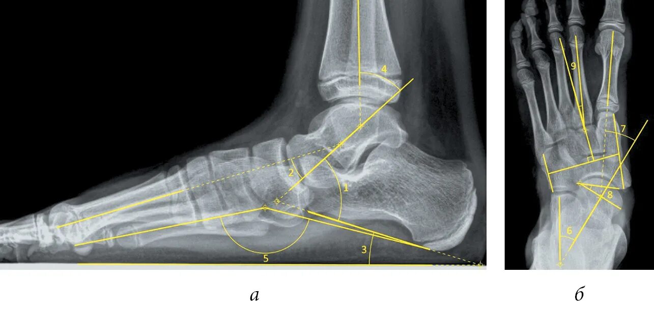 Угол голеностопного сустава. Продольное плоскостопие рентген. Голеностоп рентгенанатоми\. Рентгенодиагностика продольного плоскостопия. Стопы продольное плоскостопие рентген.