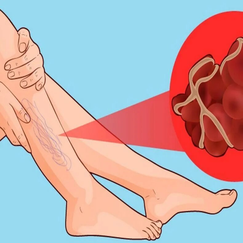 Образование тромба на ноге. Образование тромба попадание факторов