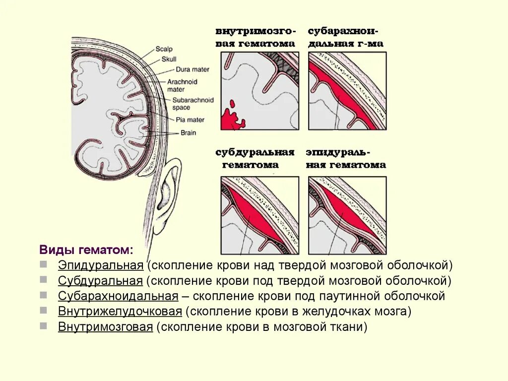 Эпидуральная субдуральная и внутримозговая гематома. Эпидуральная гематома топографическая анатомия. Субдуральное и субарахноидальное кровоизлияние схема. Субдуральная гематома черепа. Субдуральная гематома лечение