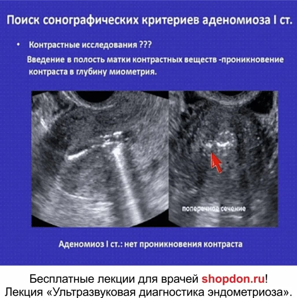 Диагностические критерии аденомиоза. Диффузная форма аденомиоза 3 степени.