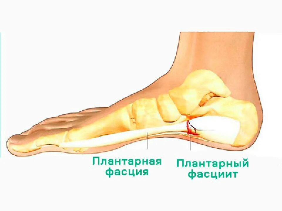 Подошвенный фасциит что это такое. Подошвенный (плантарный) фасциит. Плантарный фасциит терапия. Пяточная шпора и подошвенный фасциит. Плантарный фасциит пяточной стопы.