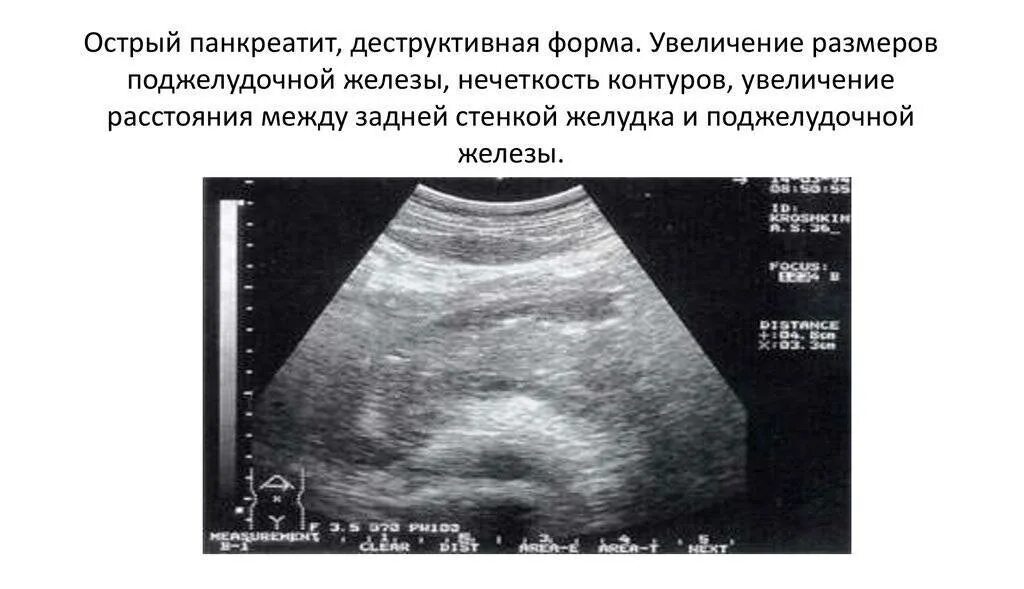 Отечная форма острого панкреатита УЗИ. УЗИ острый панкреатит УЗИ картина. Ультрасонография поджелудочной железы. Отечный панкреатит на УЗИ. На узи видно поджелудочную железу