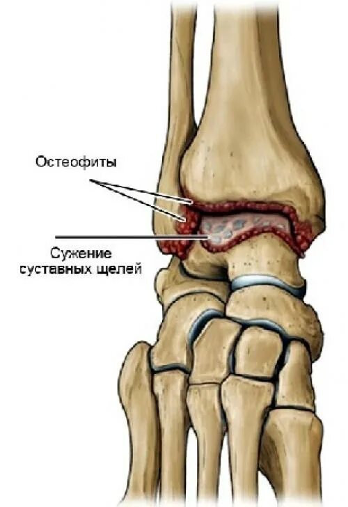 Голеностопный сустав клиника. Остеофит таранной кости. Артродез голеностопного сустава. Таранная кость стопы остеофит. Посттравматический деформирующий артроз голеностопного сустава.