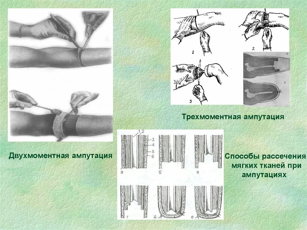 Двухмоментная круговая ампутация. Одномоментная круговая ампутация. Трехмоментная ампутация бедра по Пирогову инструменты. Одномоментная ампутация и двухмоментная Трехмоментная.