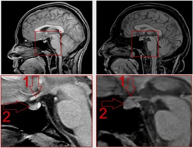 Аденома гипофиз мозга что это такое. Супраселлярная аденома гипофиза мрт. Микроаденома гипофиза головного мозга на кт. Аденома гипофиза снимок мрт. Аденома гипофиза патология.