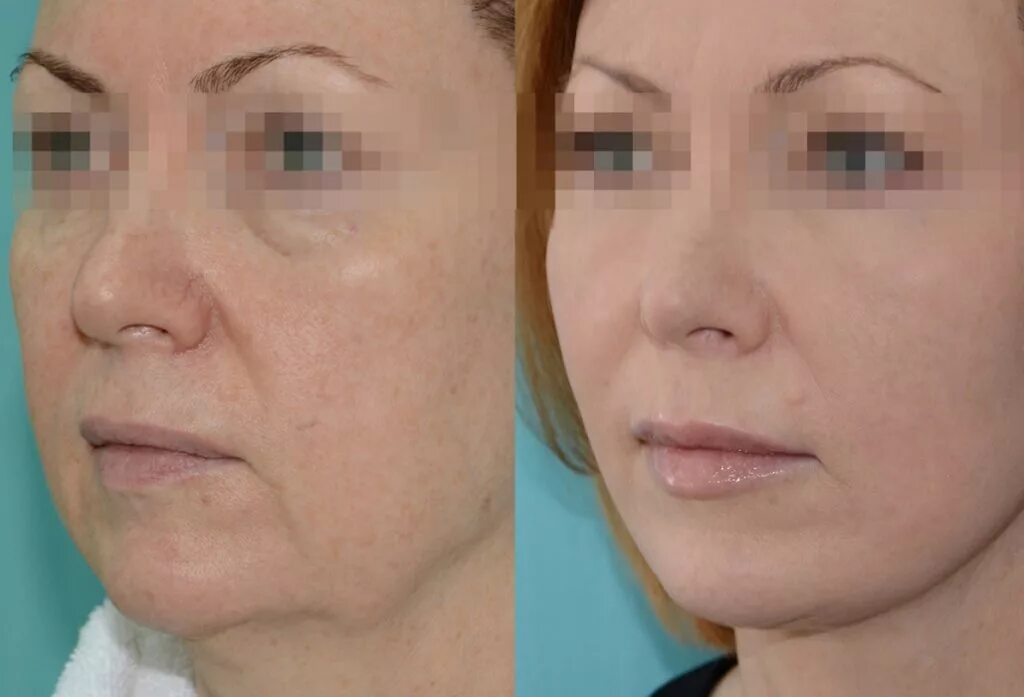 Пластика лица екатеринбург. Пластика лица екатеринбург. Блефаропластика шанталь. Эндоскопическая периобипоастика. Эндоскопическая подтяжка, smas-подтяжка,.