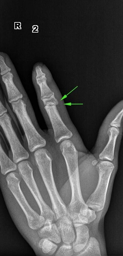 Смещение кости на руке без перелома. Перелом фаланги пальца рентген. Перелом фаланги кисти рентген. Перелом 2 пястной кости. Перелом фаланги мизинца рентген.