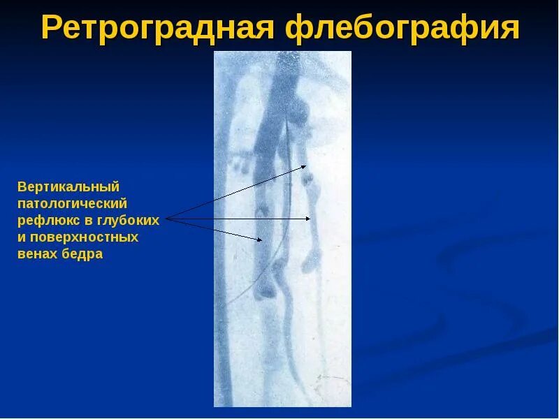 Тромбоз вен нижних конечностей на флебографии. Основные факторы патогенеза. Ретроградная вена. Ретроградная вена. Подкожная вена нижней конечности анатомия.