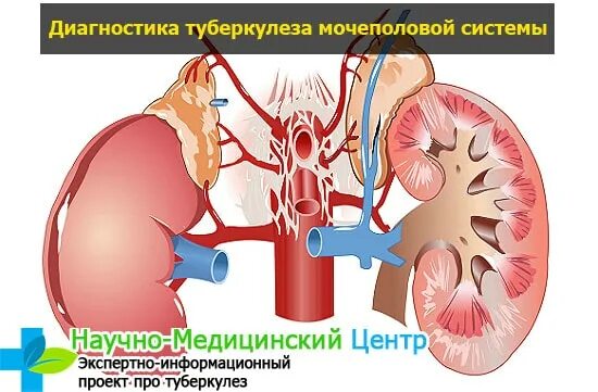 Туберкулез мочевой системы