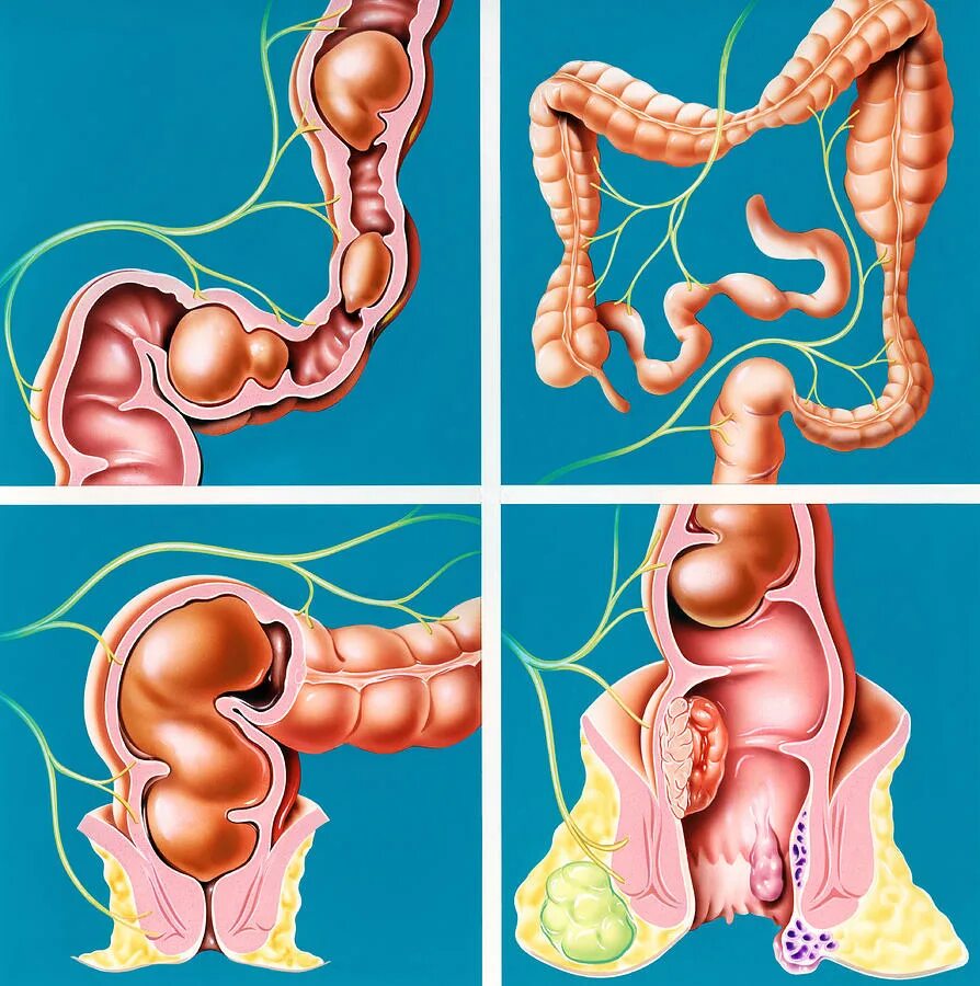 Дефекация при запоре. Что такое долихосигма. Проктосигмоидит. Запор.
