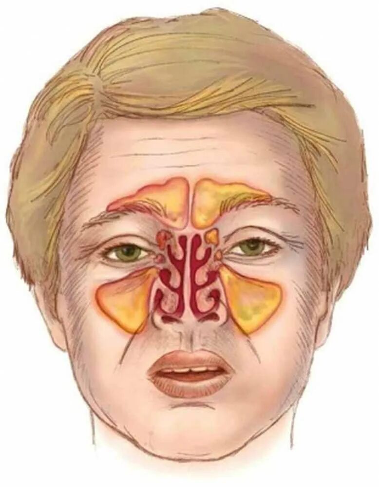 Сильно забит нос. Гайморовы пазухи гайморит. Синусит гайморит фронтит. Катаральный пансинусит.