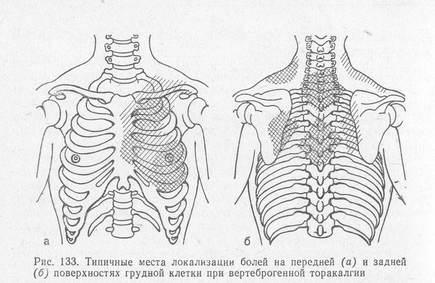 Боль между ребрами спины. Торакалгия грудного отдела позвоночника. Остеохондроз грудного отдела позвоночника торакалгия. Торакалгия болевой синдром.