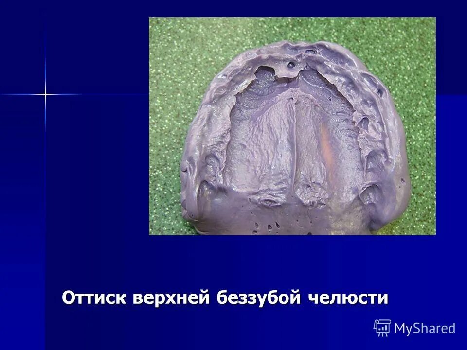 гаврилову). оттиски беззубых челюстей. оттиски зубых челюстей. слепок индивидуальной ложкой. компрессионный оттиск (по е.