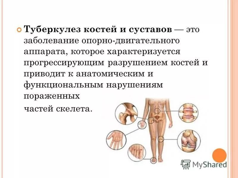 Костно-суставной туберкулез симптомы. Туберкулез костей и суставов. Туберкулёз костей и суставов симптомы. Туберкулёз кости симптомы.