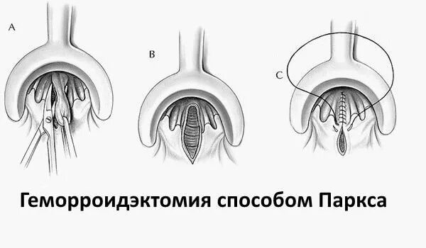 Как выглядит операция на геморрой Мерзликин Н.В. Клиническая хирургия Стр 29