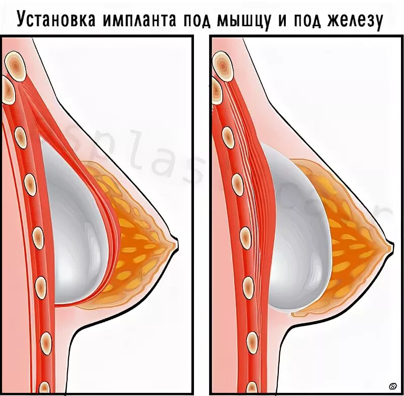 Импланты грудных желез. Аугментация под грудную мышцу. Имплант под грудную мышцу. Грудные импланты под мышцу. Импланты молочных желез под мышцу.