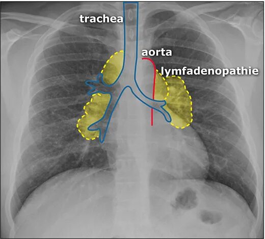 Лимфаденопатия средостения легких. Медиастинальная лимфаденопатия. Медиастал ная лимфоденопатия. Внутригрудная лимфаденопатия. Лимфаденопатия внутригрудных лимфатических узлов.