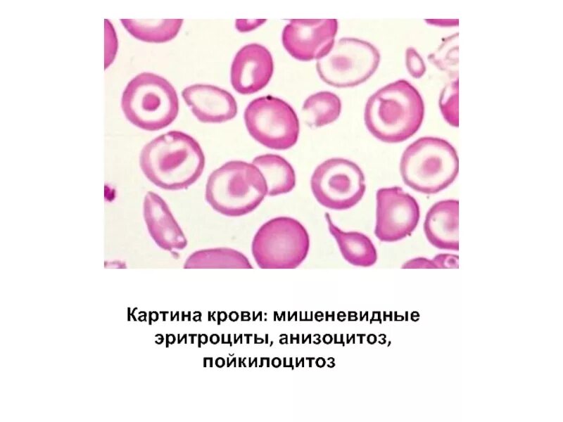 Пойкилоцитоз анемия. Мишеневидные эритроциты. Анизоцитоз и пойкилоцитоз. Гемолитическая анемия пойкилоцитоз. Микроцитоз анизоцитоз пойкилоцитоз.