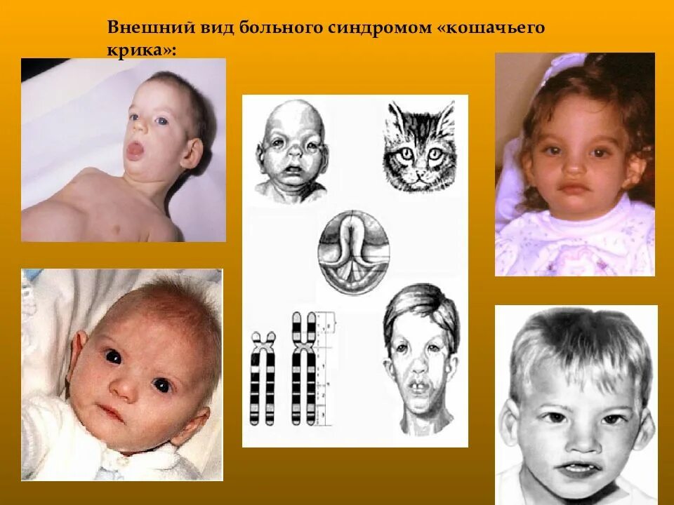 Кошачья болезнь у детей