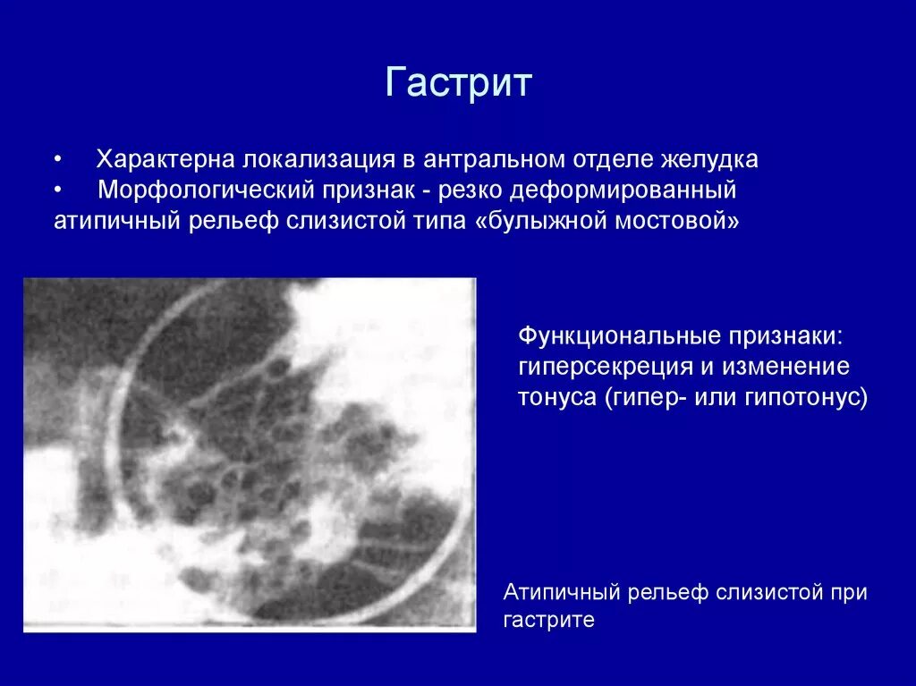 Локализация боли при гастрите. Слизистая антрального отдела желудка. Локализация боли в животе при гастрите. Боль при антральном гастрите. Гастрит локализация