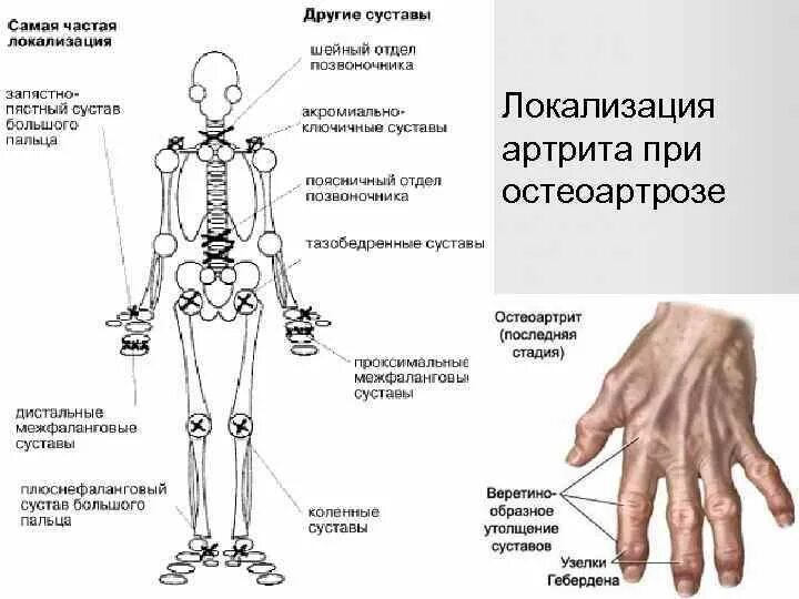 Реактивный артрит локализация. Реактивный артрит симптомы. Реактивный артрит клиническая картина. Реактивный артрит после