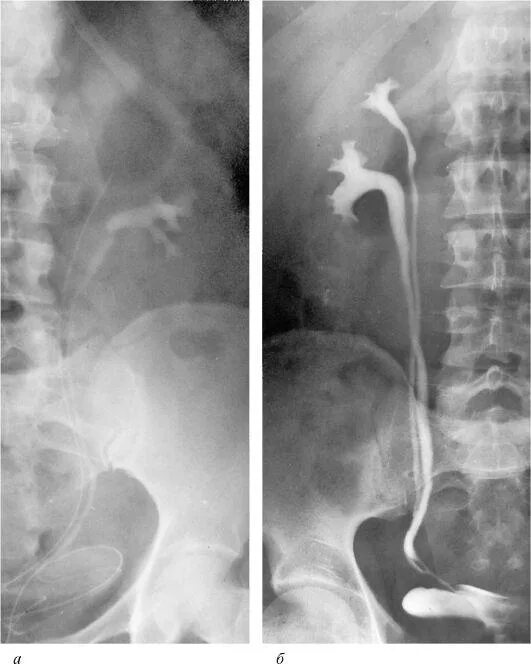 Удвоение мочеточника. Удвоение лоханки почки рентген. Аплазия мочеточника рентген. Удвоение почки экскреторная урография. Аномалии лоханок почки.