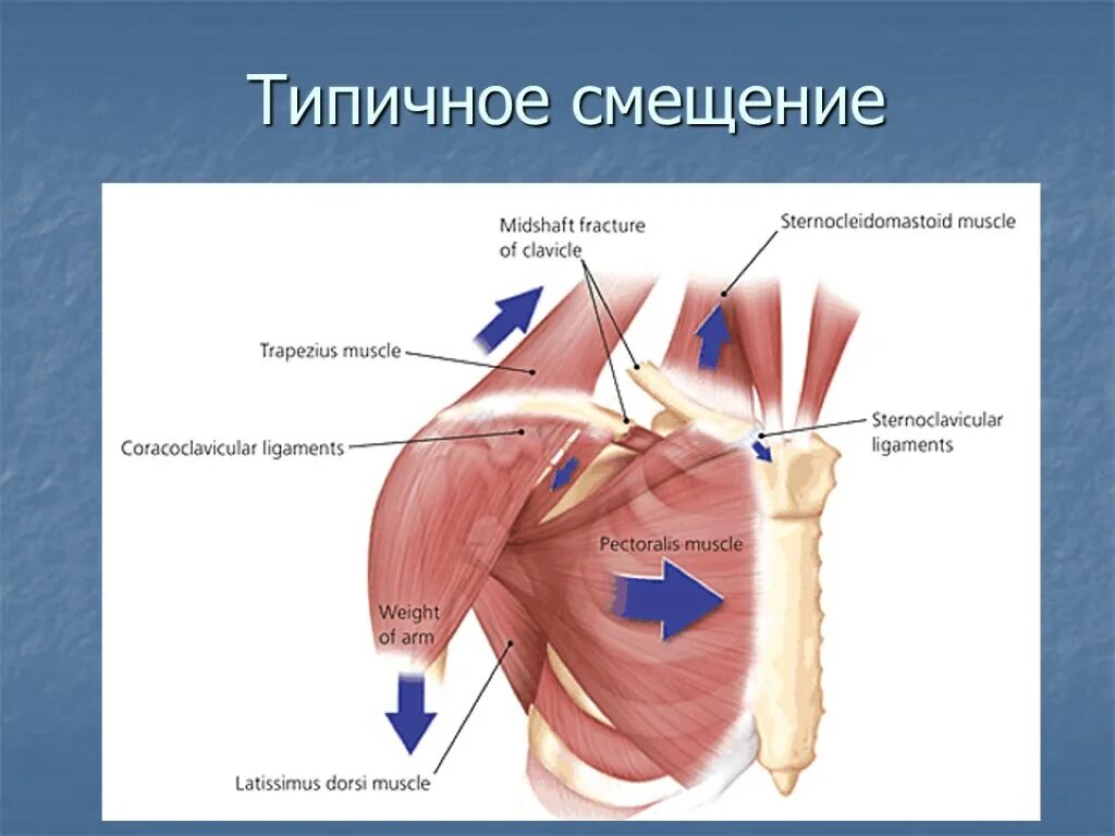 Мышца над ключицей