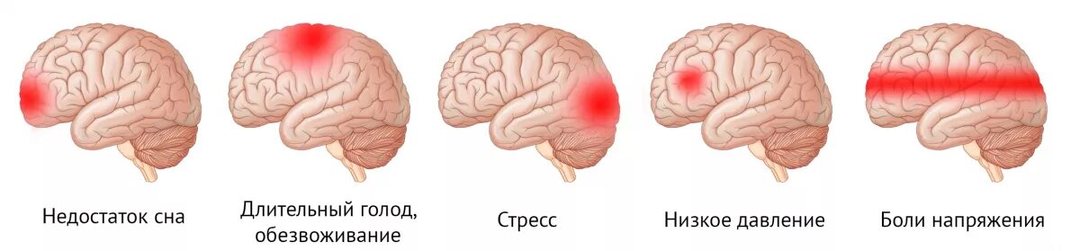 Исчезли головные боли. Боль в лобной доле головы. Болит макушка головы. Причины головной боли.