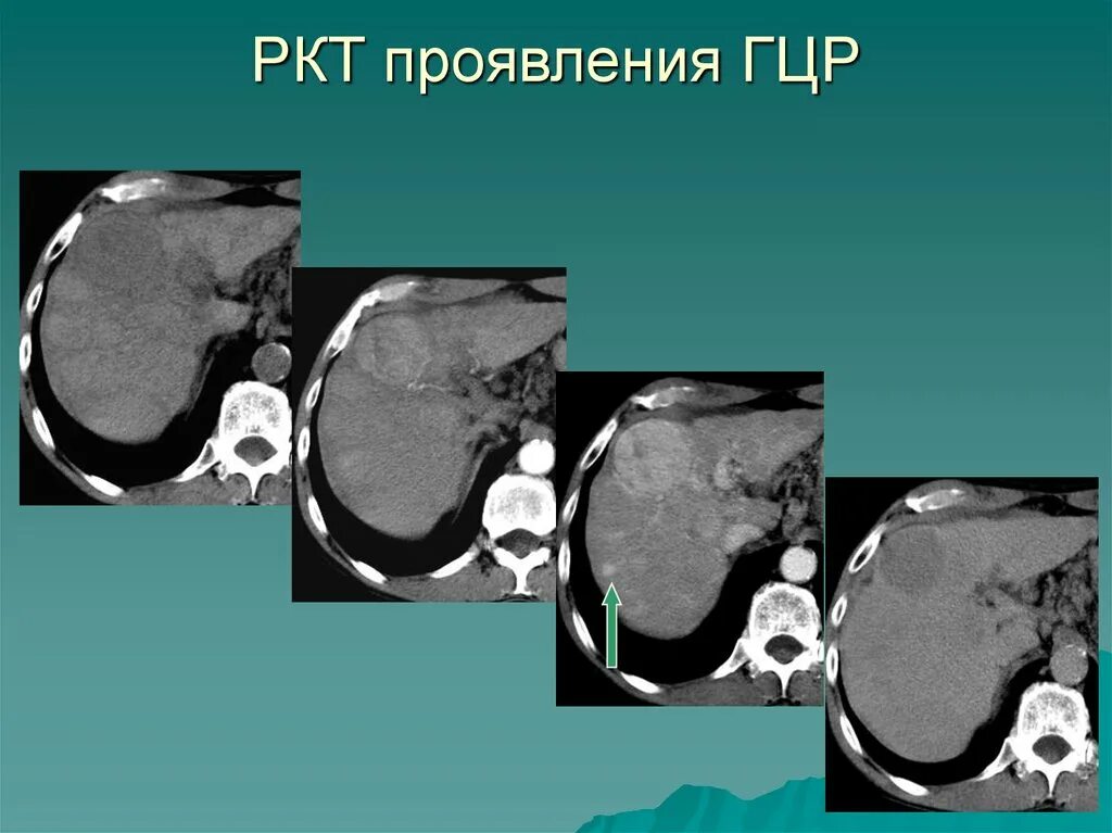 Что такое ркт. Гепатоцеллюлярная карцинома печени кт.