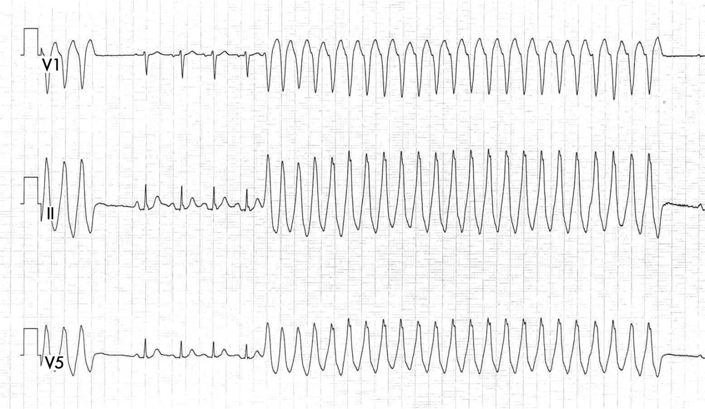 фибрилляция желудочков у детей