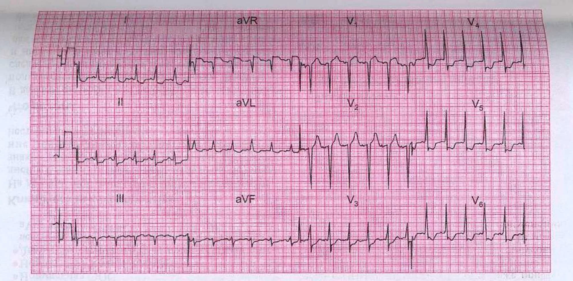 Ишемия передней стенки. Ишемия миокарда на ЭКГ. ЭКГ ИБС постинфарктный кардиосклероз. ЭКГ при ИБС стенокардия напряжения гипертрофия левого желудочка. ЭКГ при ИБС: постинфарктный кардиосклероз.