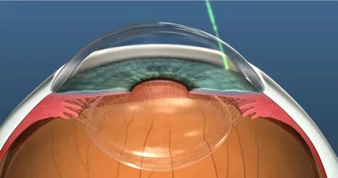 Glaucoma