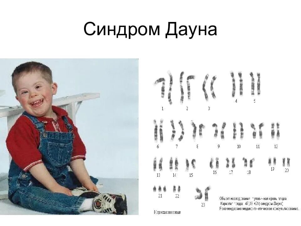 Синдром Дауна. Варианты синдрома дауна